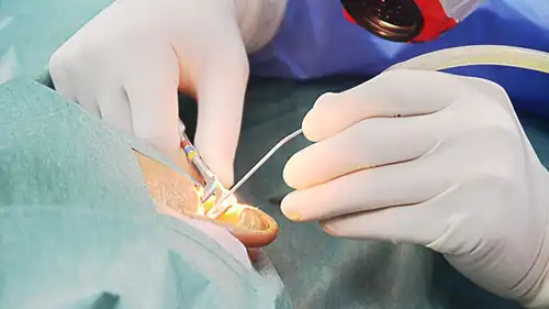 Mastoidectomy Surgery