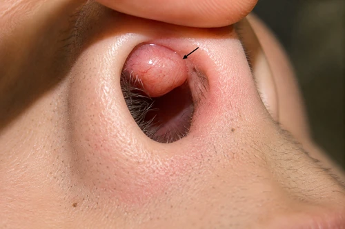 Nasal Tumours