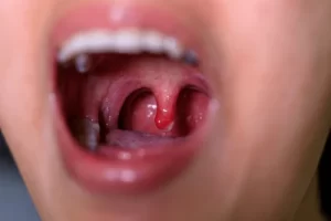 Tonsillitis
