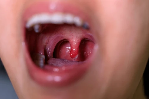 Tonsillitis