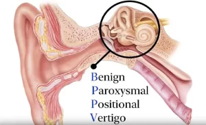 Benign Paroxysmal Positional Vertigo (BPPV)
