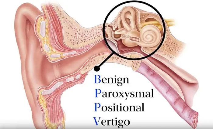 Benign Paroxysmal Positional Vertigo (BPPV)