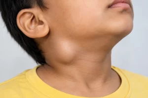 Branchial Cyst