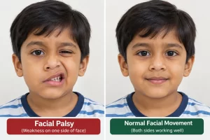 Facial Palsy