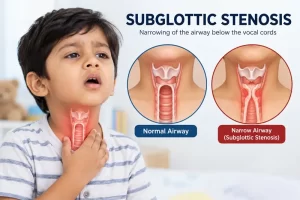 Subglottic Stenosis in Children