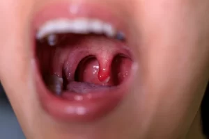 Tonsillitis in Children