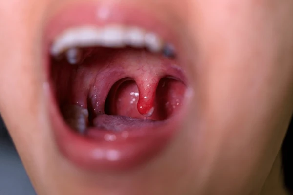 Tonsillitis in Children