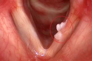 Vocal Cord Tumor