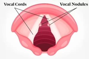Vocal Nodules