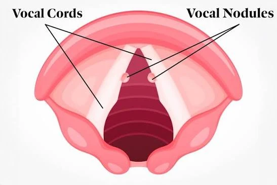 Vocal Nodules