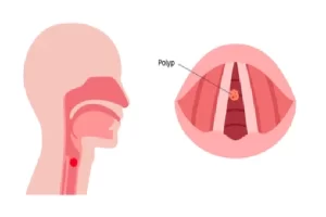 Vocal Polyps
